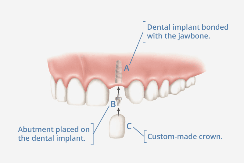 Dental Implant expert