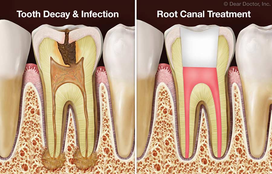 Combined Root Canal & Gum Problems - Dental Innovations - Mark DShirley,  DDS - Oklahoma City Oklahoma