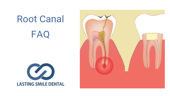 Root  Canal Frequently Asked Questions